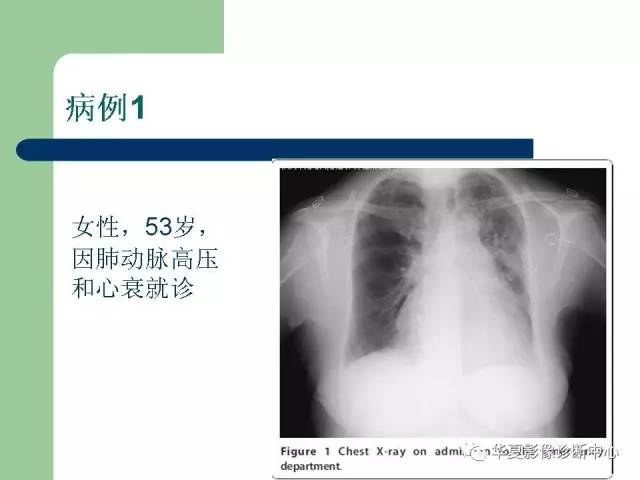 【PPT】单侧透明肺