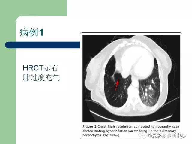 【PPT】单侧透明肺
