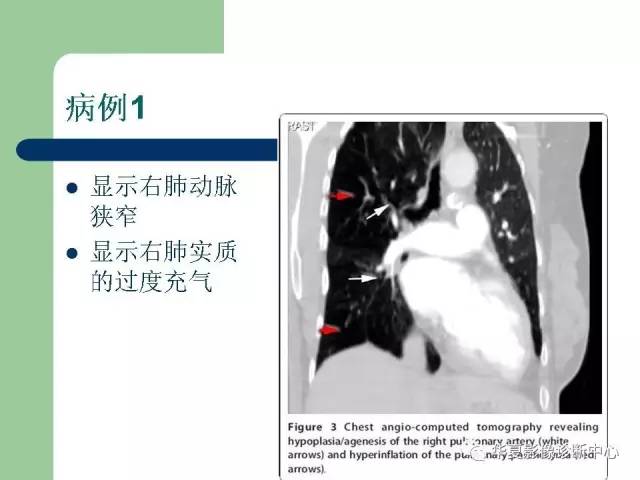 【PPT】单侧透明肺