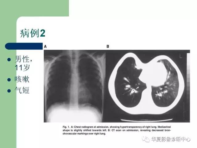 【PPT】单侧透明肺