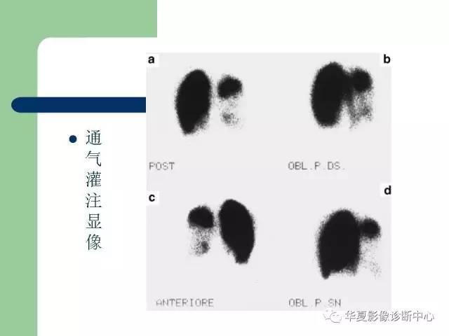 【PPT】单侧透明肺