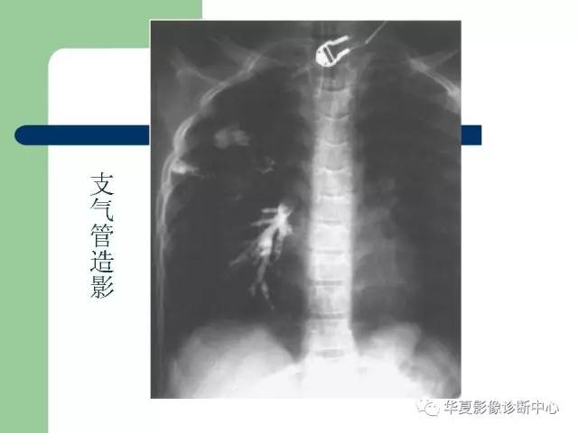 【PPT】单侧透明肺
