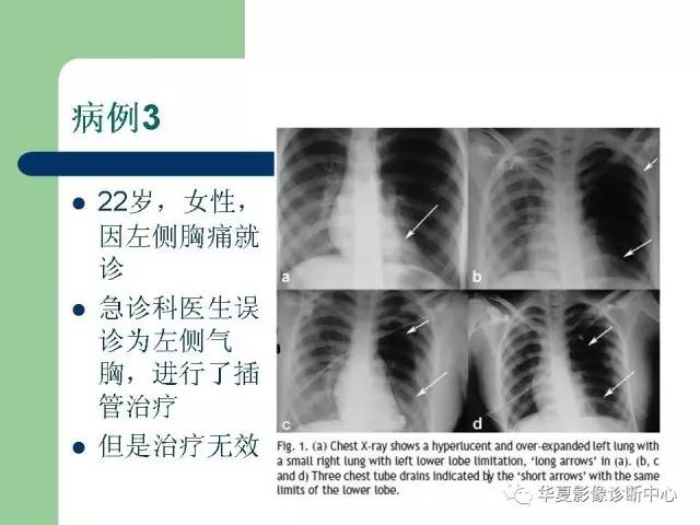 【PPT】单侧透明肺