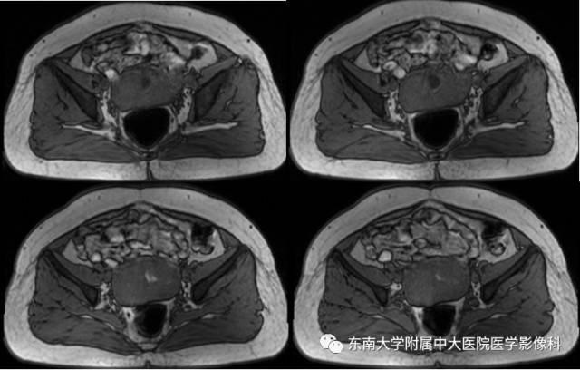 【病例】瘢痕妊娠1例MR