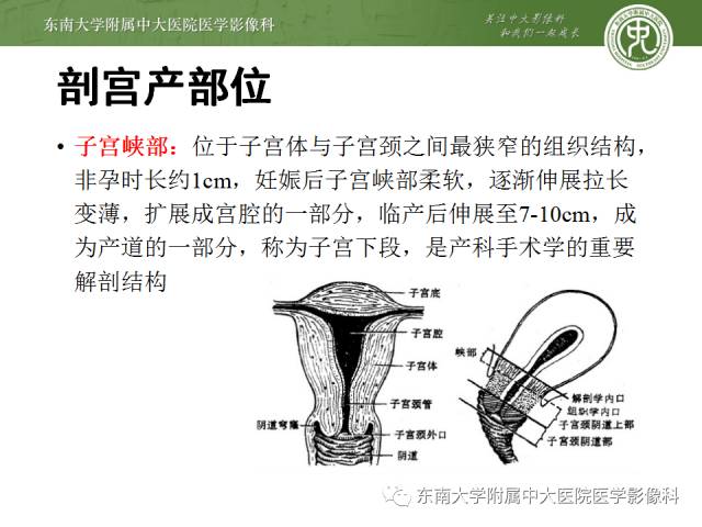【病例】瘢痕妊娠1例MR