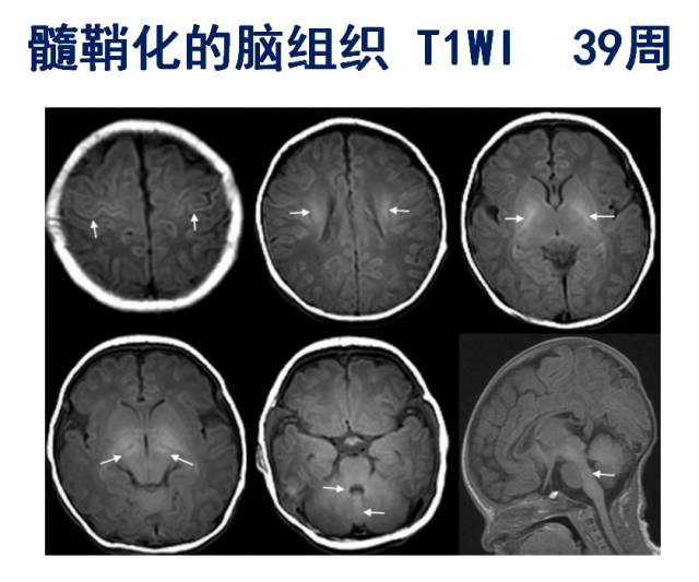 【PPT】髓鞘发育的MRI表现