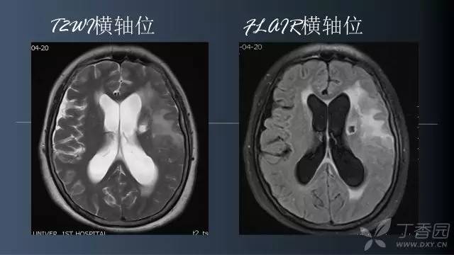 【病例】颅内单发环形强化病例—脑脓肿1例MRI影像分析