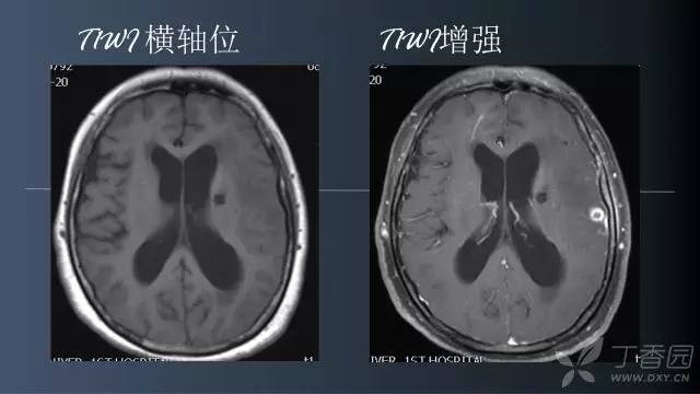 【病例】颅内单发环形强化病例—脑脓肿1例MRI影像分析