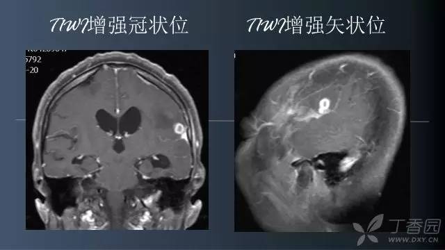 【病例】颅内单发环形强化病例—脑脓肿1例MRI影像分析