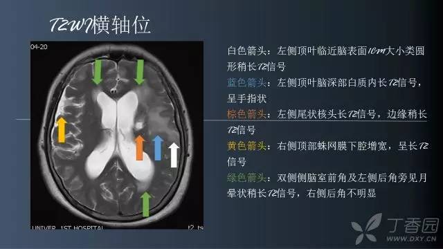 【病例】颅内单发环形强化病例—脑脓肿1例MRI影像分析