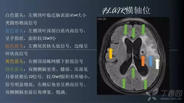 【病例】颅内单发环形强化病例—脑脓肿1例MRI影像分析