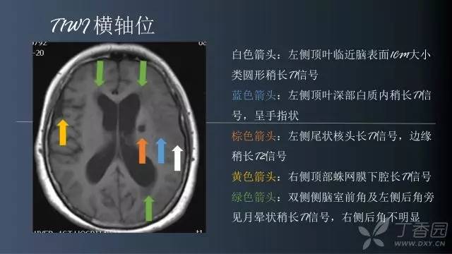 【病例】颅内单发环形强化病例—脑脓肿1例MRI影像分析