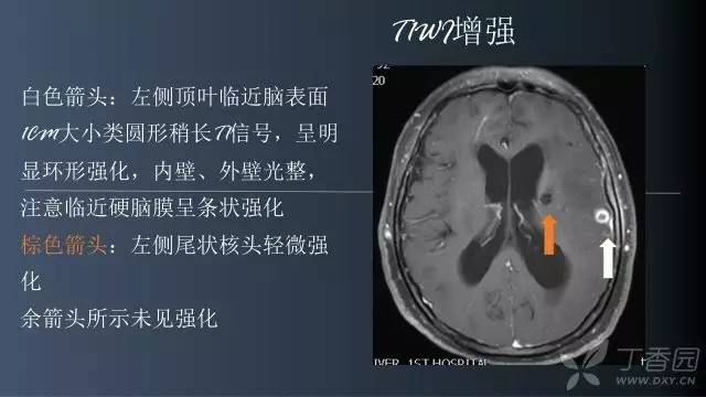 【病例】颅内单发环形强化病例—脑脓肿1例MRI影像分析