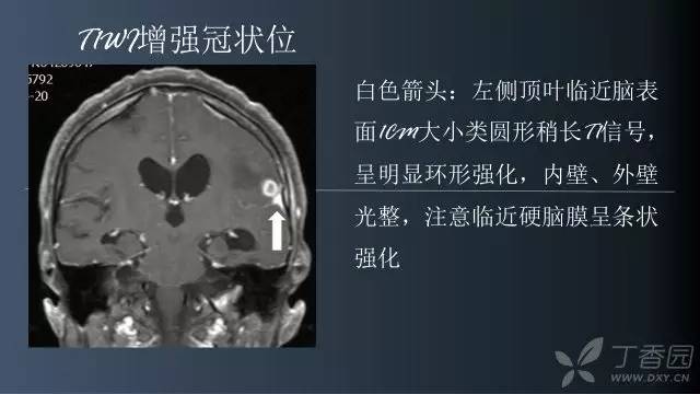 【病例】颅内单发环形强化病例—脑脓肿1例MRI影像分析