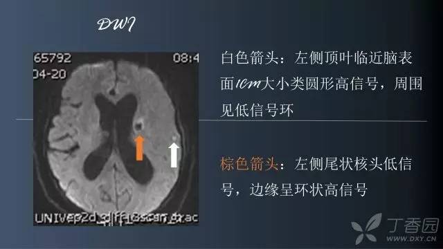 【病例】颅内单发环形强化病例—脑脓肿1例MRI影像分析