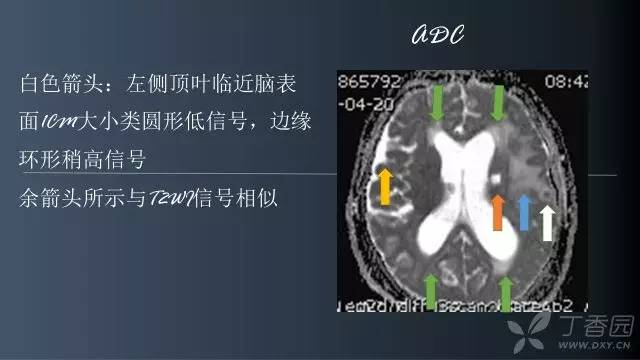 【病例】颅内单发环形强化病例—脑脓肿1例MRI影像分析