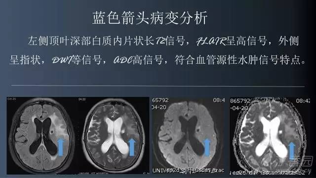 【病例】颅内单发环形强化病例—脑脓肿1例MRI影像分析
