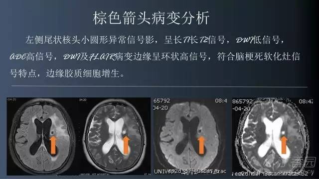 【病例】颅内单发环形强化病例—脑脓肿1例MRI影像分析