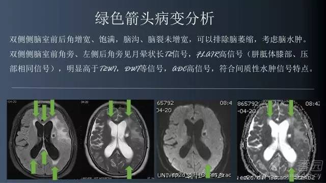 【病例】颅内单发环形强化病例—脑脓肿1例MRI影像分析