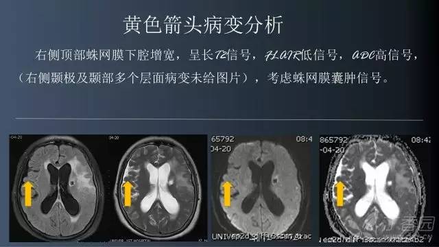 【病例】颅内单发环形强化病例—脑脓肿1例MRI影像分析