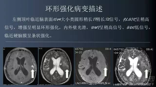 【病例】颅内单发环形强化病例—脑脓肿1例MRI影像分析
