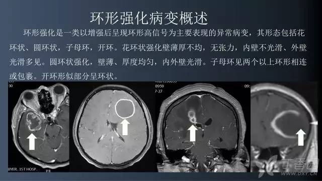 【病例】颅内单发环形强化病例—脑脓肿1例MRI影像分析