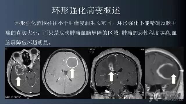 【病例】颅内单发环形强化病例—脑脓肿1例MRI影像分析