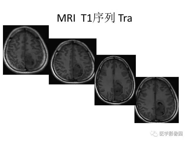 【病例】大脑镰旁占位—间变性星形细胞瘤1例MR