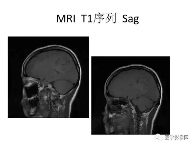 【病例】大脑镰旁占位—间变性星形细胞瘤1例MR