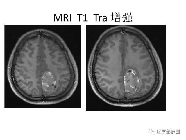 【病例】大脑镰旁占位—间变性星形细胞瘤1例MR