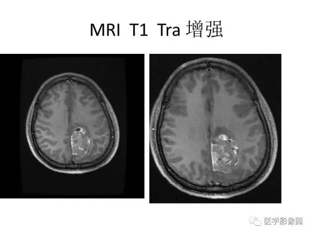 【病例】大脑镰旁占位—间变性星形细胞瘤1例MR