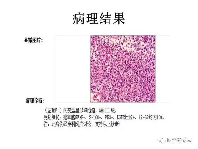 【病例】大脑镰旁占位—间变性星形细胞瘤1例MR