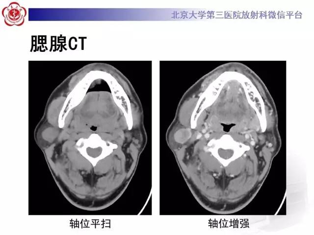 【病例】腮腺腺淋巴瘤1例CT及MR影像诊断