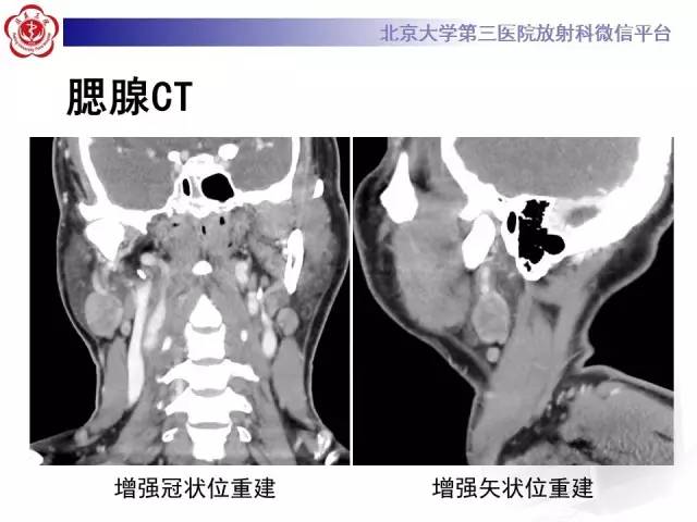 【病例】腮腺腺淋巴瘤1例CT及MR影像诊断