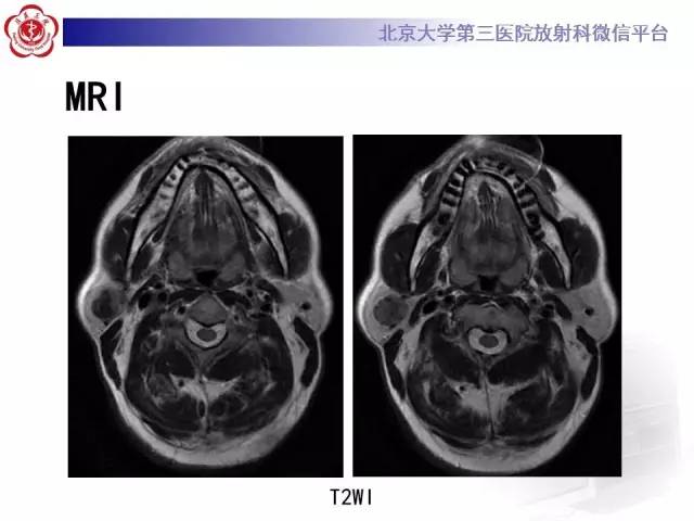 【病例】腮腺腺淋巴瘤1例CT及MR影像诊断