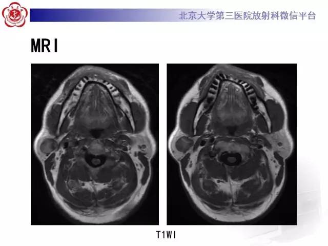 【病例】腮腺腺淋巴瘤1例CT及MR影像诊断