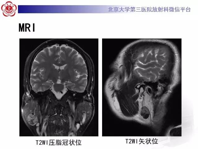 【病例】腮腺腺淋巴瘤1例CT及MR影像诊断