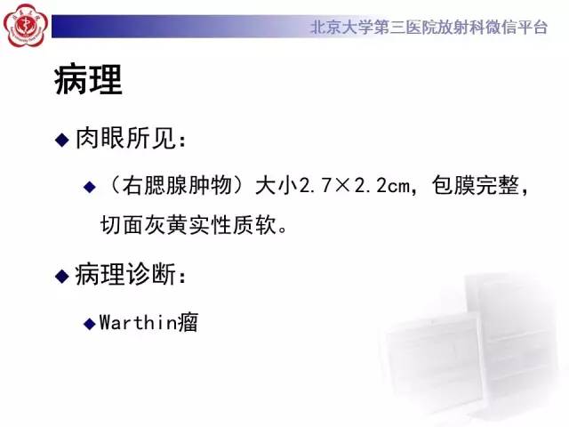 【病例】腮腺腺淋巴瘤1例CT及MR影像诊断