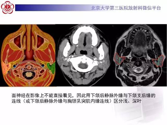 【病例】腮腺腺淋巴瘤1例CT及MR影像诊断
