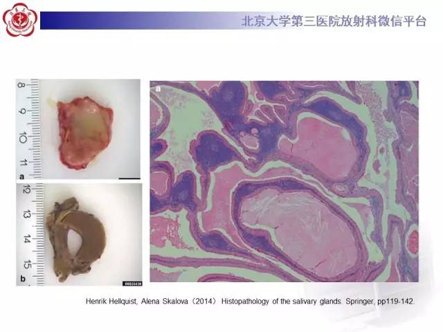 【病例】腮腺腺淋巴瘤1例CT及MR影像诊断