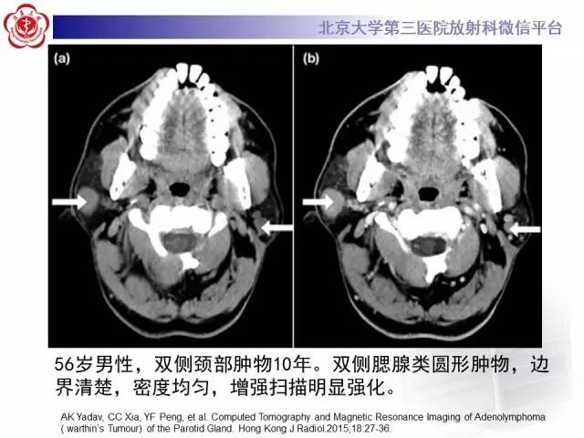 【病例】腮腺腺淋巴瘤1例CT及MR影像诊断