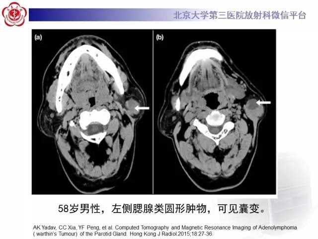 【病例】腮腺腺淋巴瘤1例CT及MR影像诊断