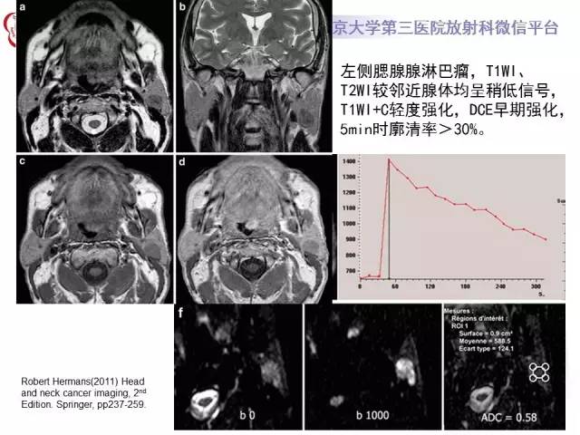 【病例】腮腺腺淋巴瘤1例CT及MR影像诊断