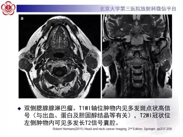 【病例】腮腺腺淋巴瘤1例CT及MR影像诊断