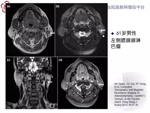 【病例】腮腺腺淋巴瘤1例CT及MR影像诊断