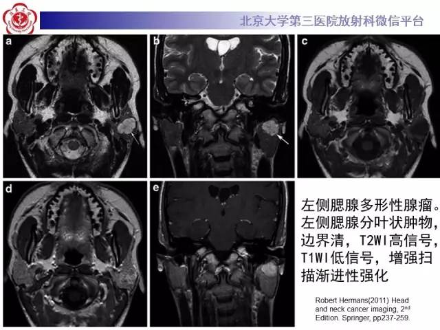 【病例】腮腺腺淋巴瘤1例CT及MR影像诊断