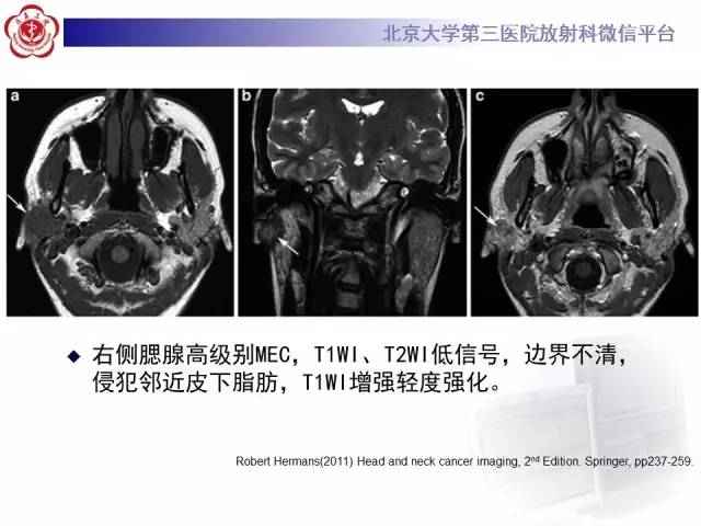 【病例】腮腺腺淋巴瘤1例CT及MR影像诊断