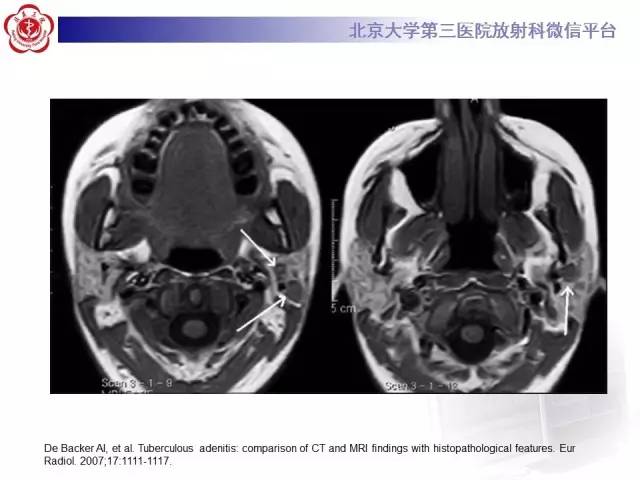 【病例】腮腺腺淋巴瘤1例CT及MR影像诊断