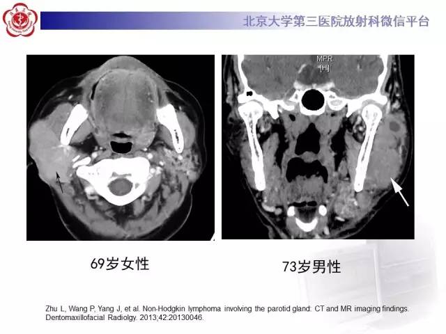 【病例】腮腺腺淋巴瘤1例CT及MR影像诊断