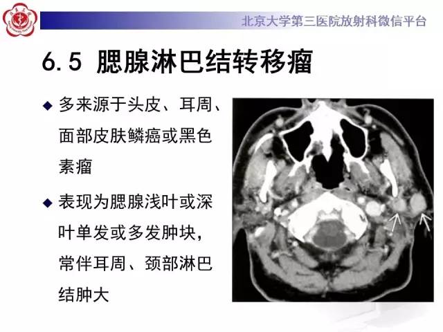 【病例】腮腺腺淋巴瘤1例CT及MR影像诊断